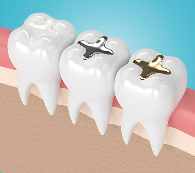 Renton Composite Fillings
