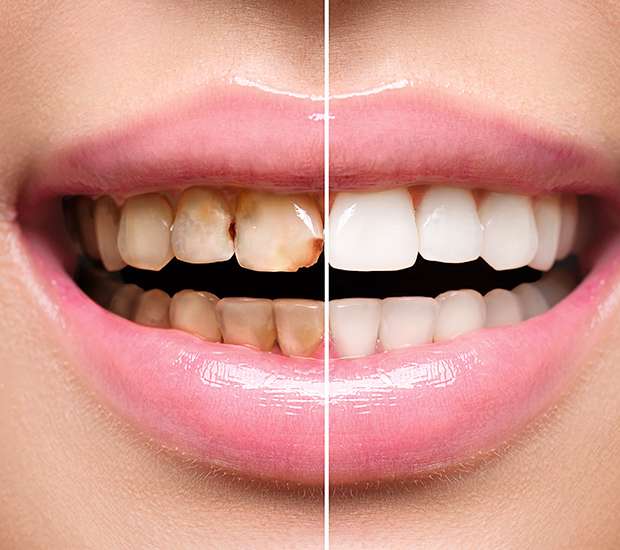 Renton Dental Implant Restoration
