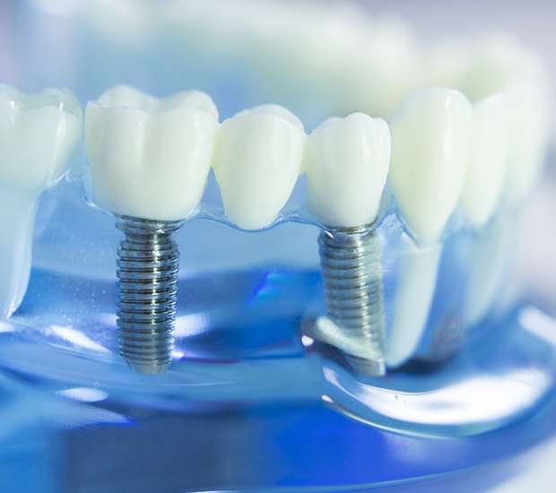 Renton Dental Implants