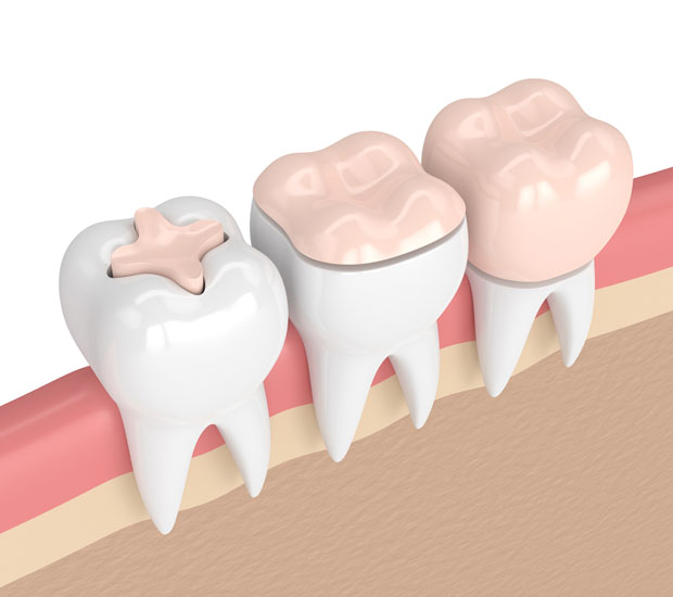 Renton Dental Inlays and Onlays
