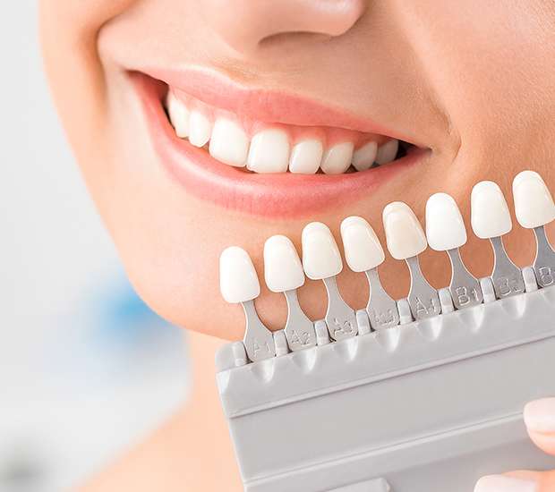 Renton Dental Veneers and Dental Laminates