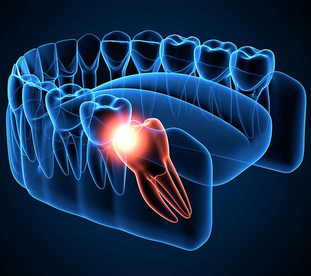 Renton Wisdom Teeth Extraction